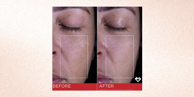 In Article Lip Wrinkles And Lines RevitaLift Triple Power Mosturizer SPF 30